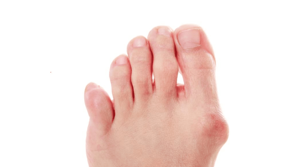 The big and little toes of one foot are bent, which leads to bunions.