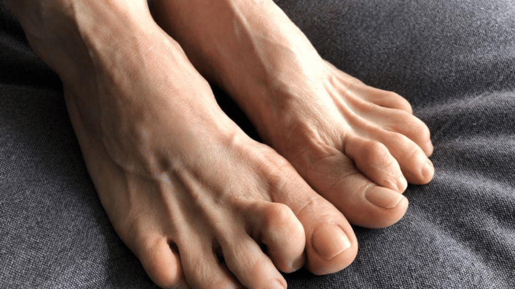 foot with severe Hammertoe