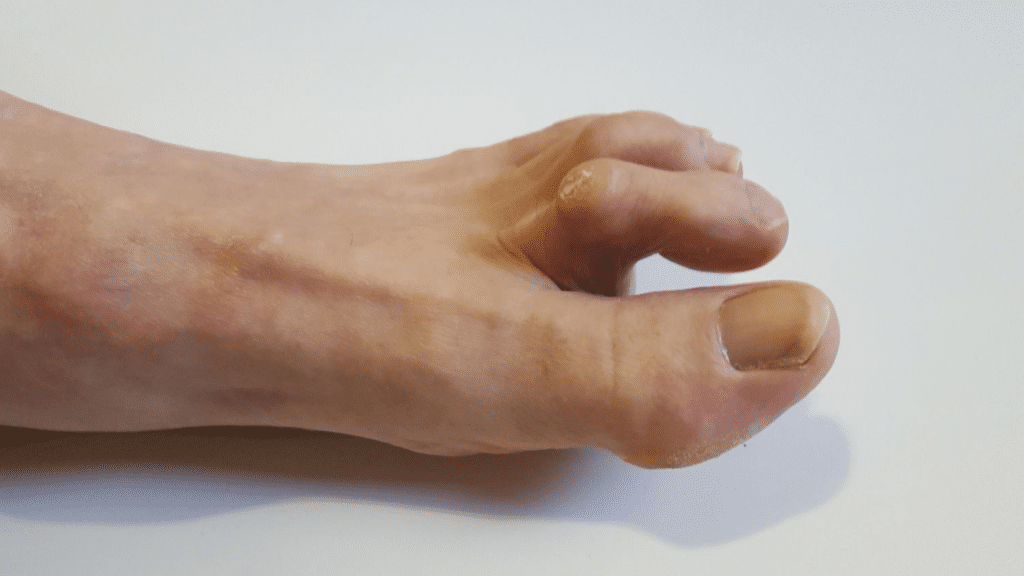 hammertoe foot