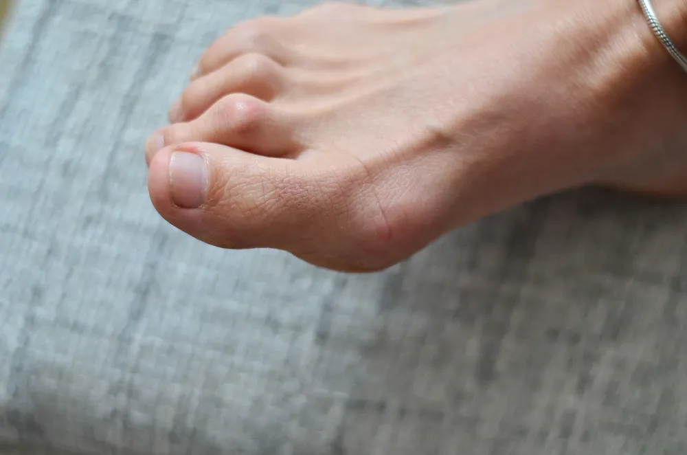 Hammertoe