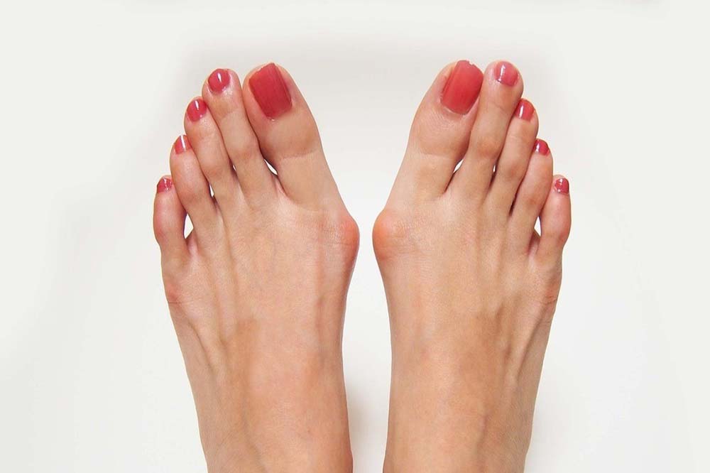 feet with bunions