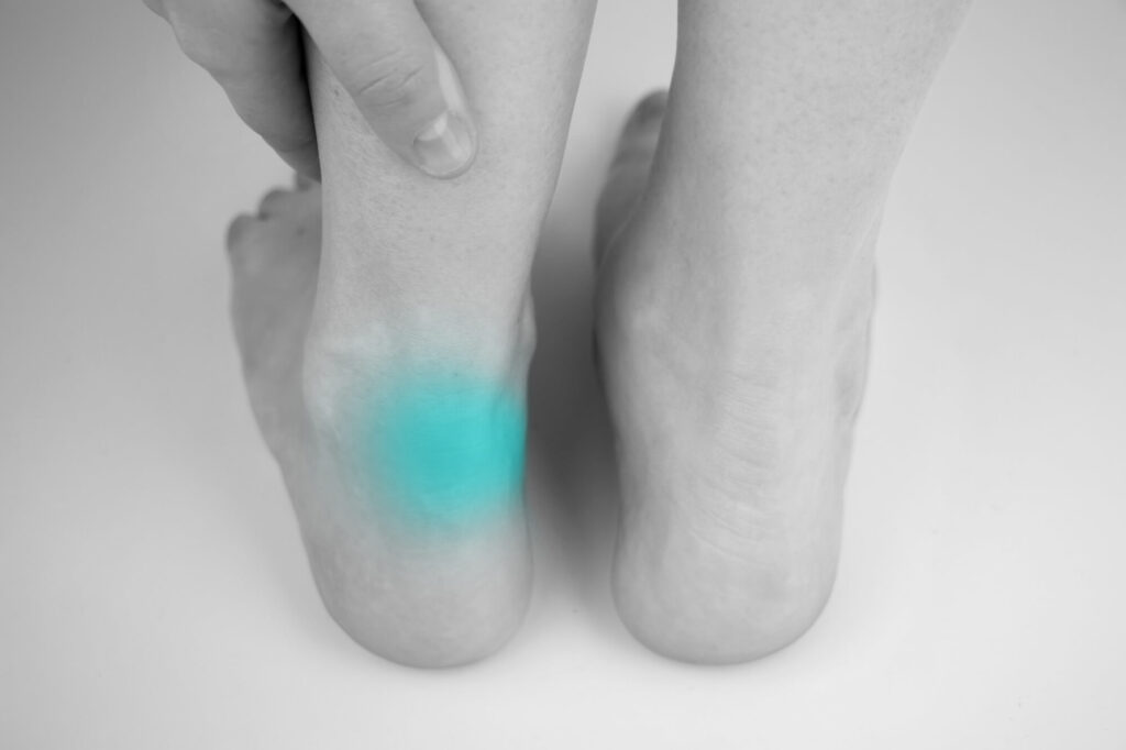 A blue spot on a foot with an achilles tendon injury.