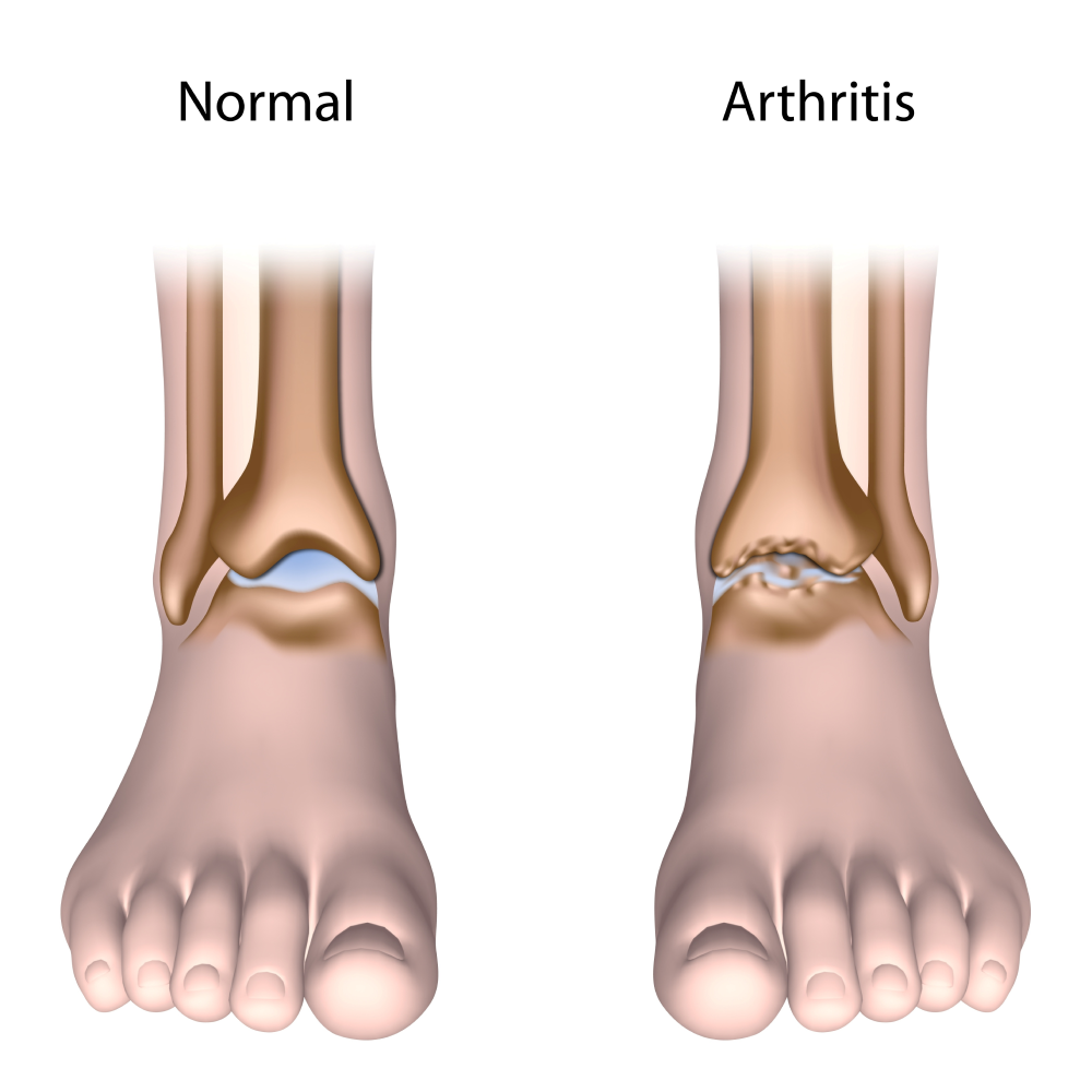 The difference between a foot with arthritis and a normal foot.