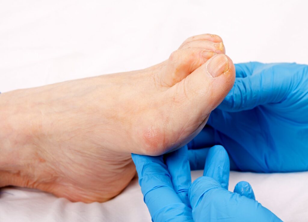 A podiatrist examines a patient's foot while wearing surgical gloves.