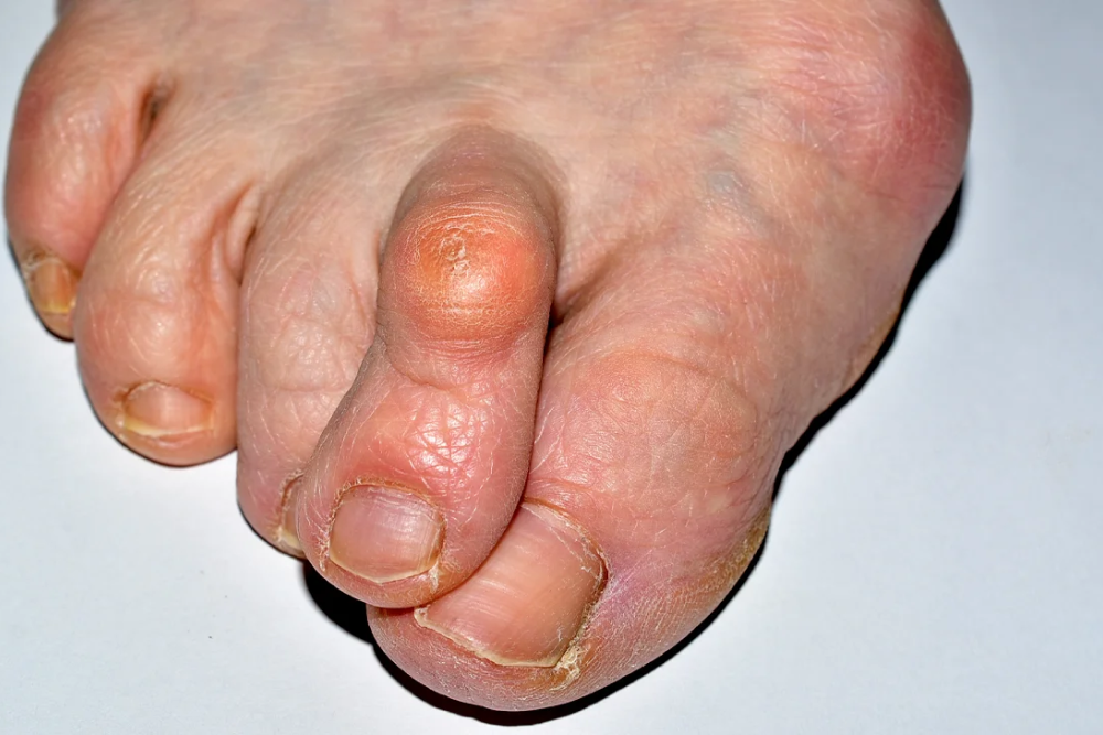 A one foot with the index toe misplaced due to arthritic condition.