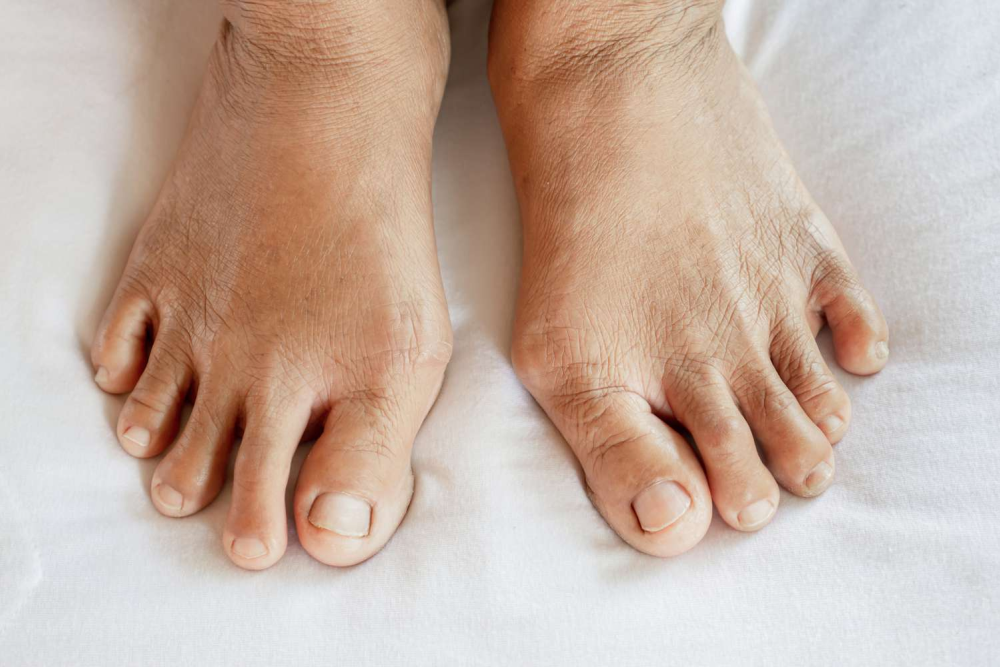 Arthritis feet in white background