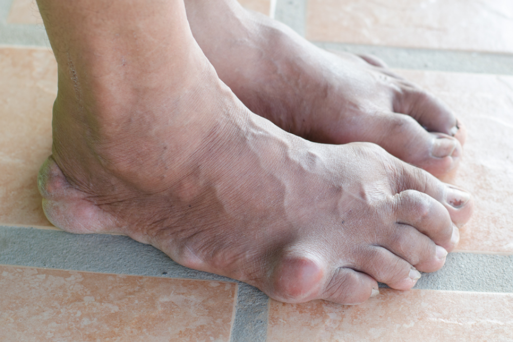 The left joint, the bent portion of the little toe, and the ankle section of the foot have all enlarged as a result of arthritis disease.