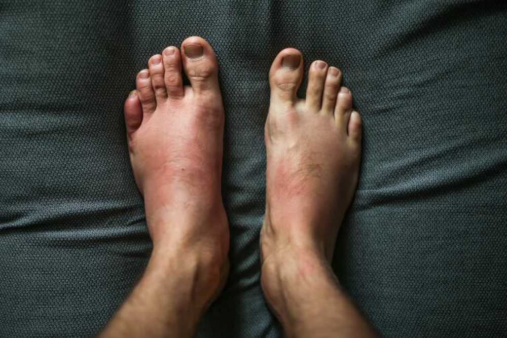 Arthritis feet