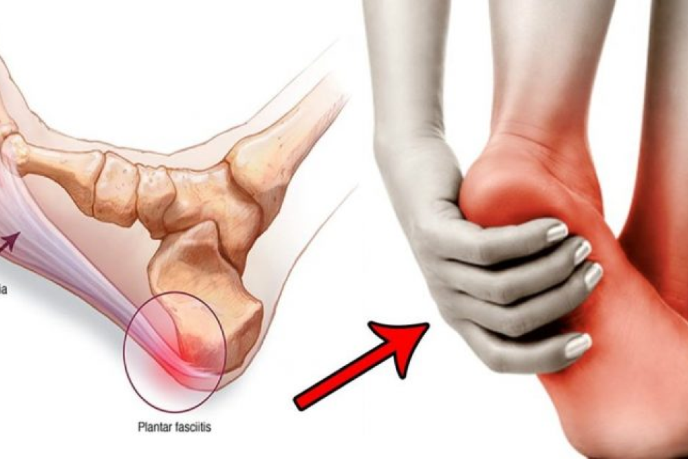 heel pain cause by plantar fasciitis