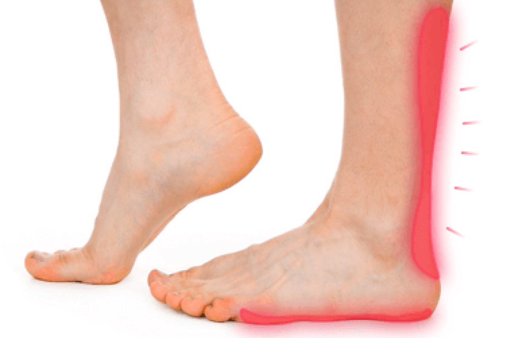 A white background foot with a red mark spot into the sole and achilles to calf.