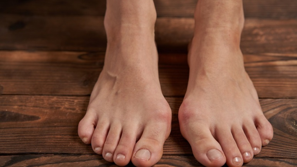 a foot with bunion on a wooden floor