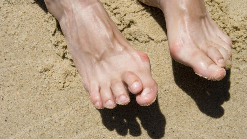 A person showing his feet with a cause bunion ailment with a sand background.