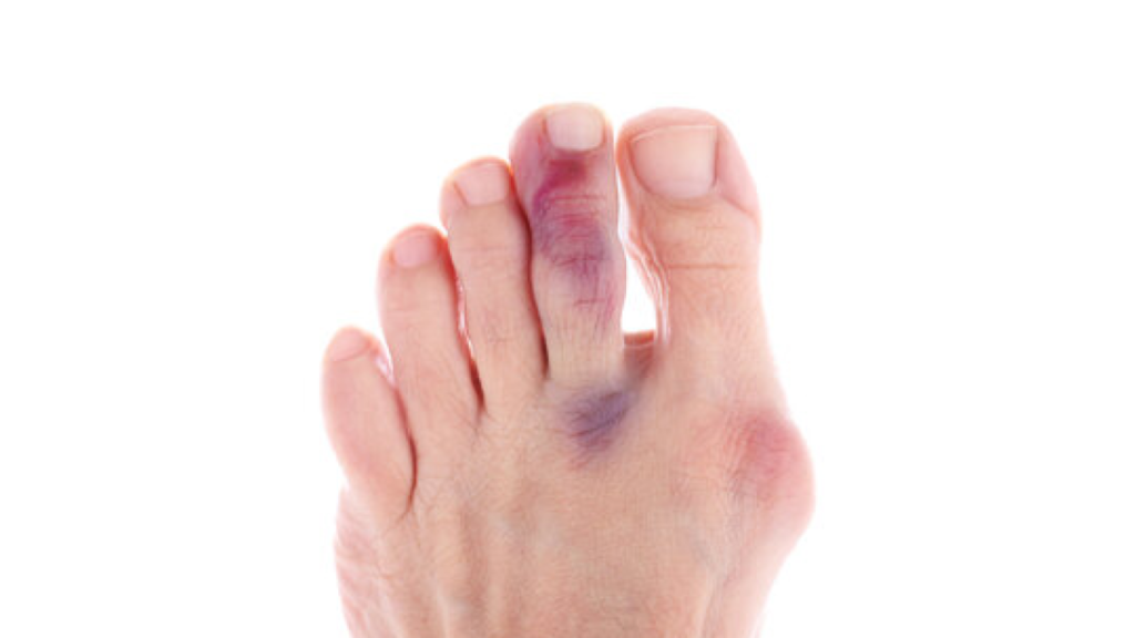 foot purple after sprain