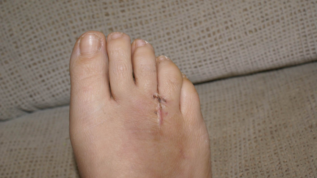 a surgery of Mortons neuroma