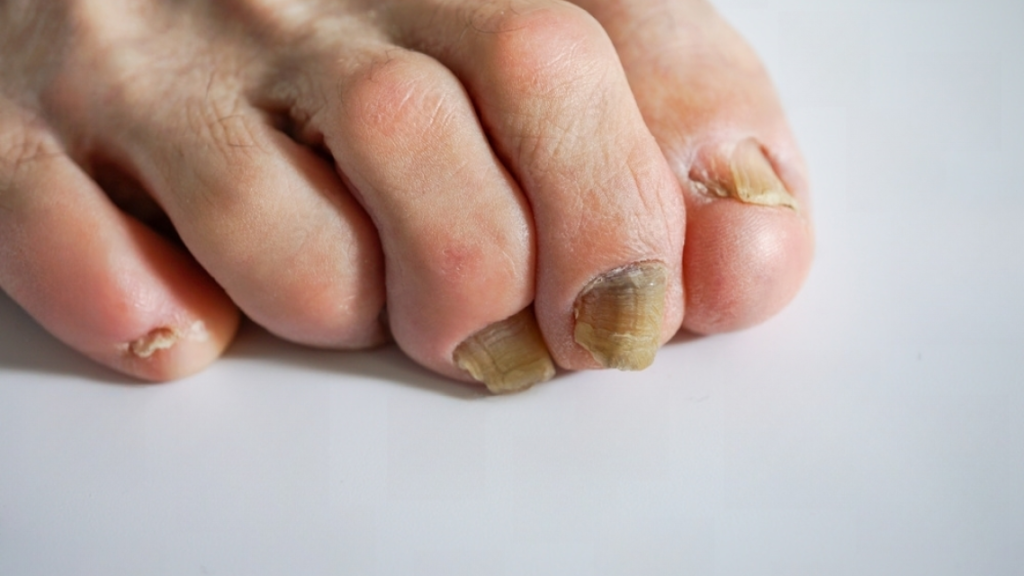 A horrible nail on one foot caused on by hammertoe issues.