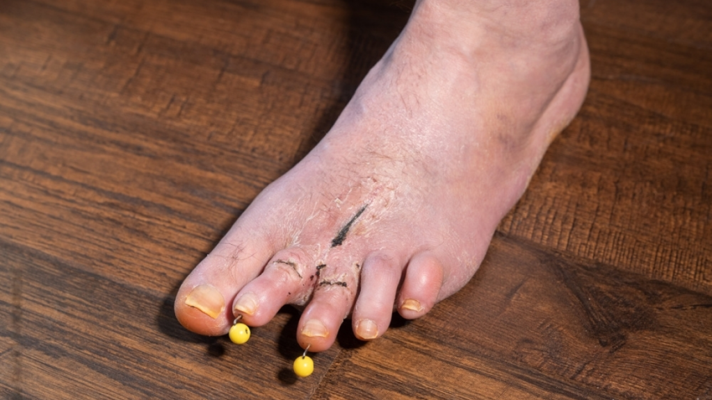 After the surgery, the foot has progressively healed and has two objects in the toes.