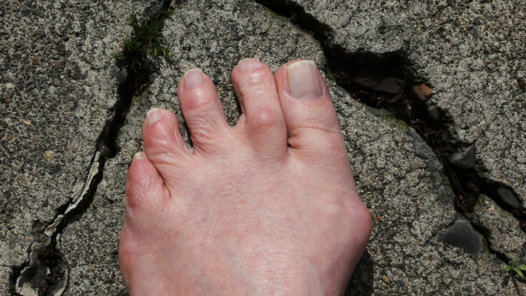 foot with hammertoe on crack road