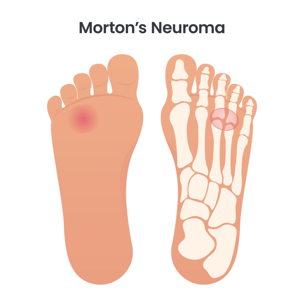 Mortons Neuroma