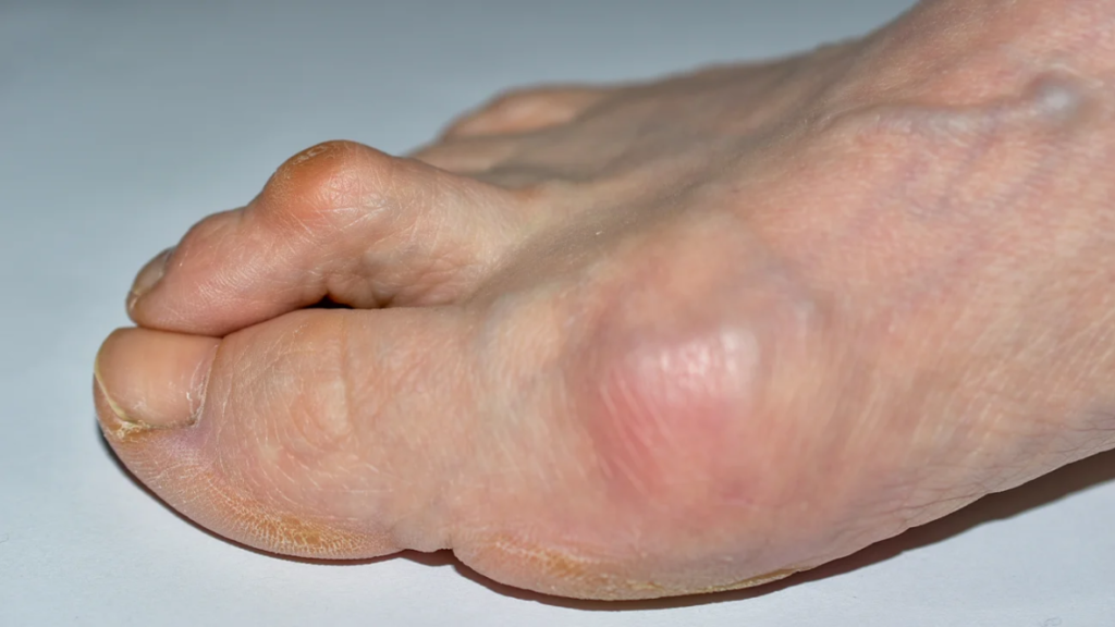 foot with hammertoe and bunion