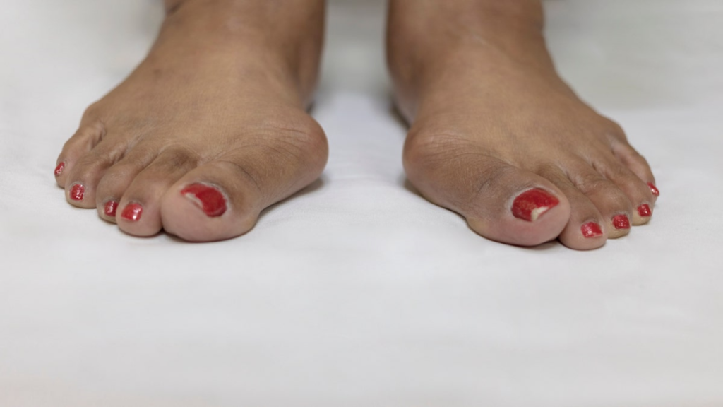 woman foot with bunion