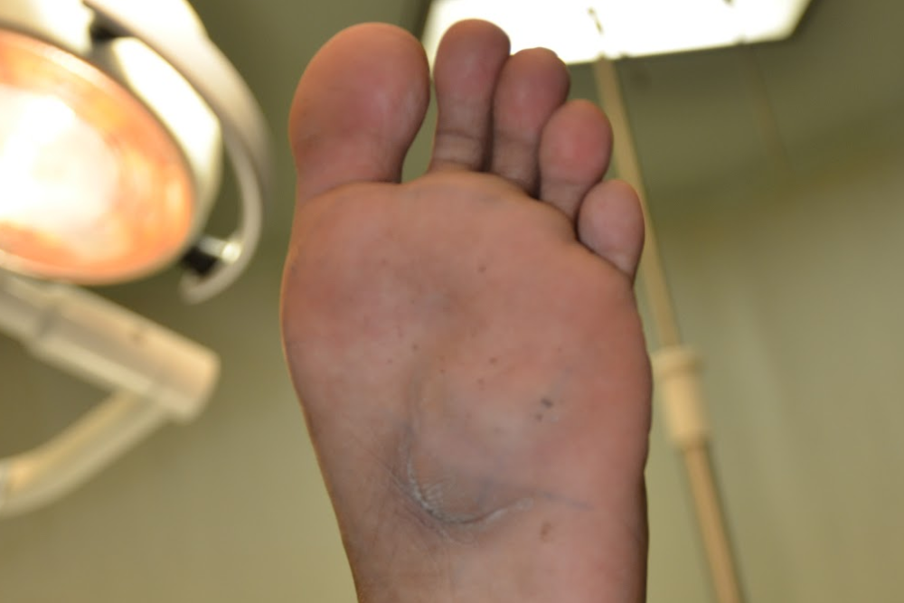 a scar from a foot Soft Tissue Mass Surgery