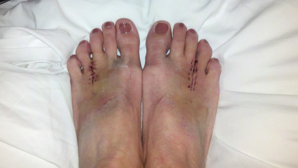 Mortons Neuroma Surgery