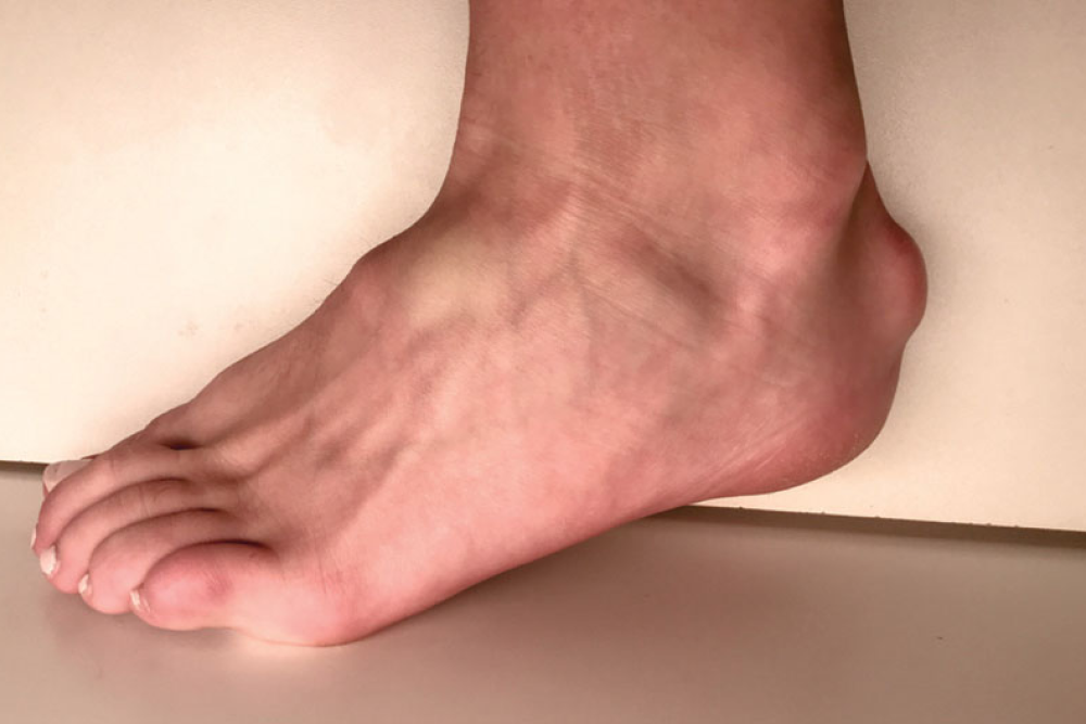 foot with lump at tendon