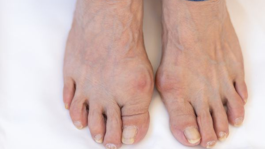 close up foot with bunion picture