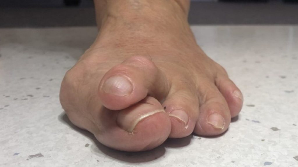 A patient shows his one foot with hammertoes.