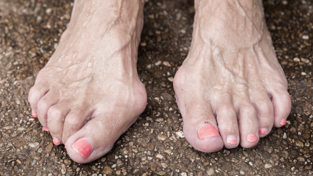 an old woman foot with hammertoe