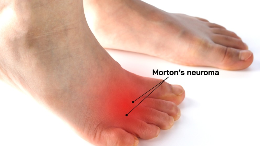 mortons neuroma on foot