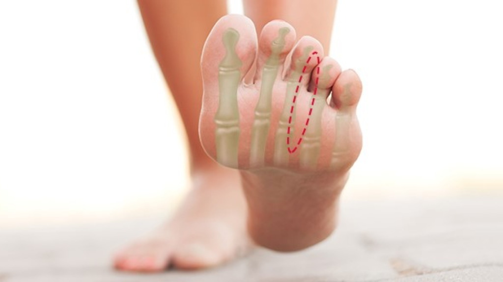 A foot has seen the bones to determine which part of the nerve are the source of Morton neuroma.