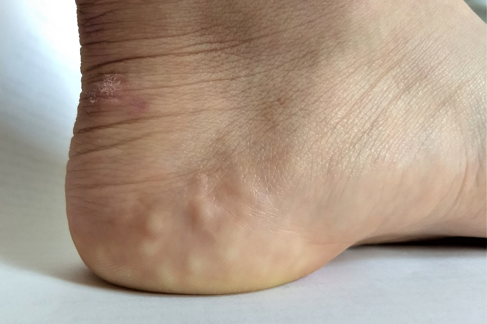 a foot with Piezogenic papules