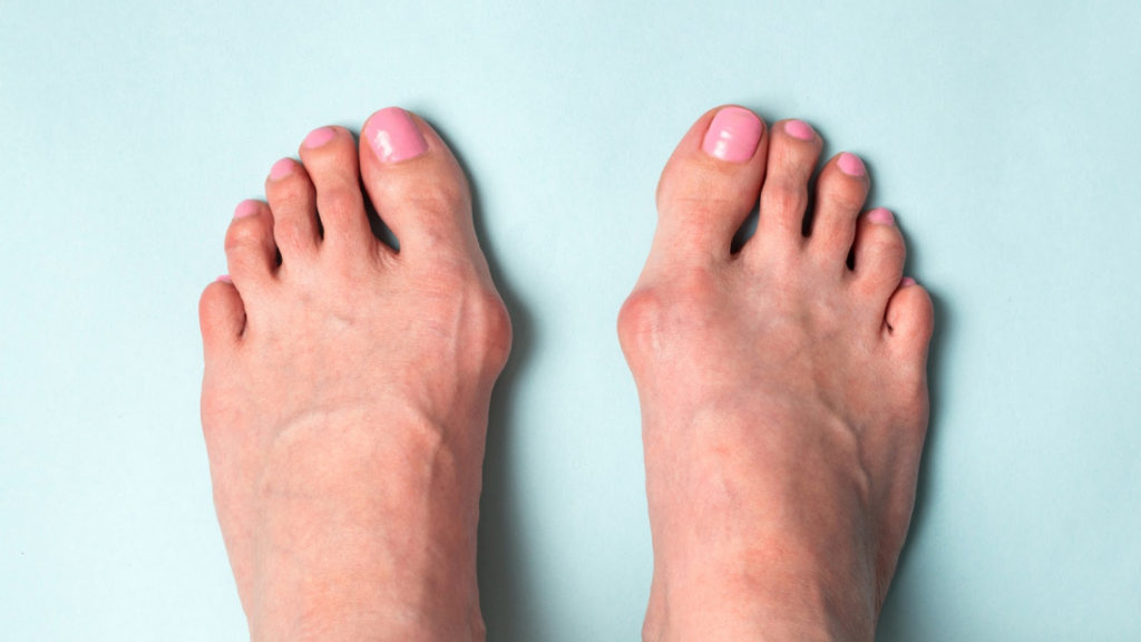 All of the big toes on both feet are bent, which leads to bunions.