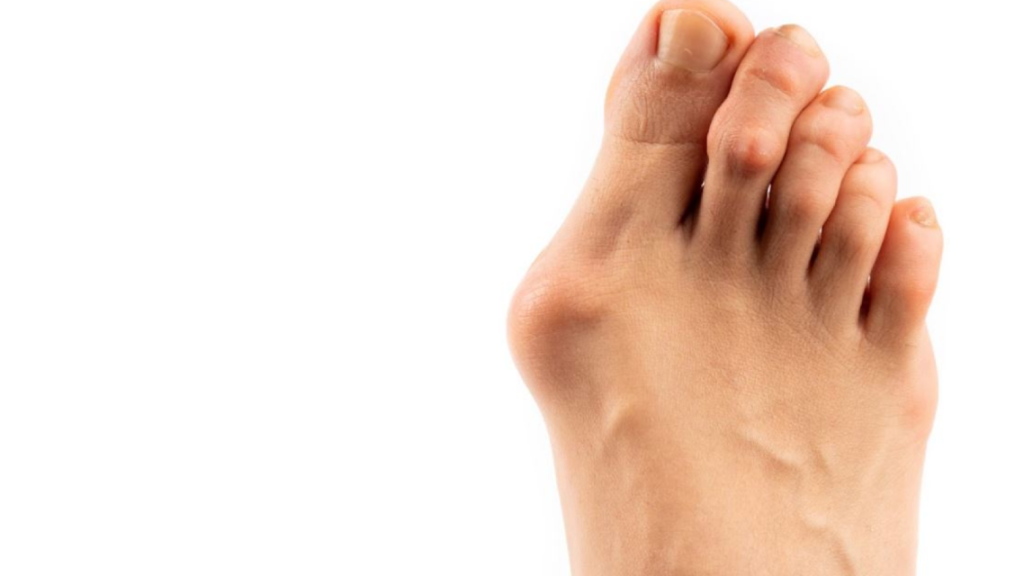 Right foot with a bunion and hammer toe