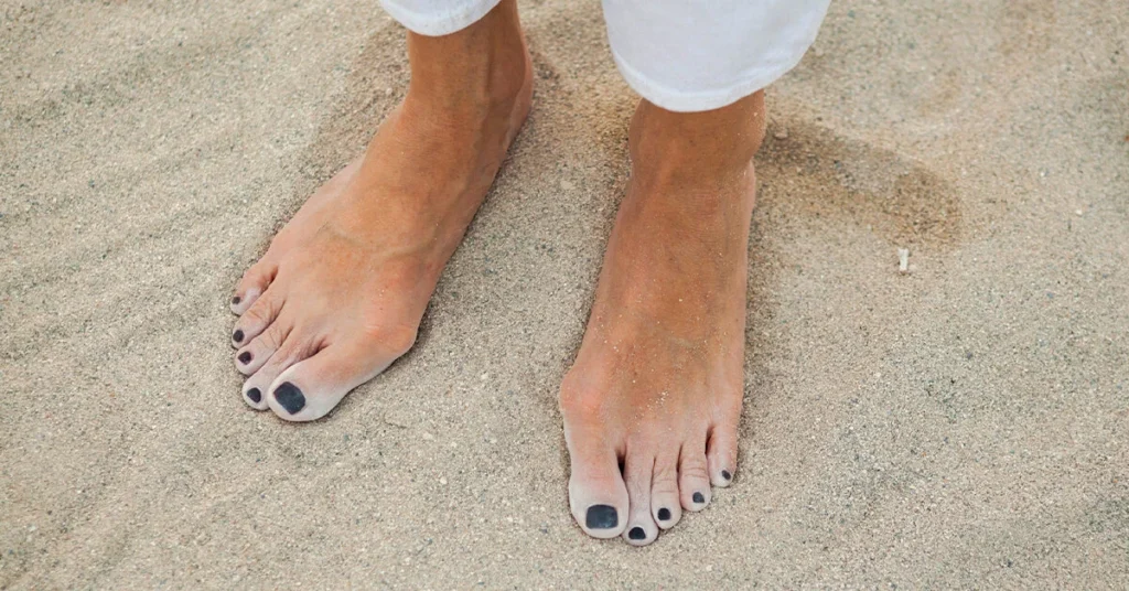 woman foot with bunion on a sand