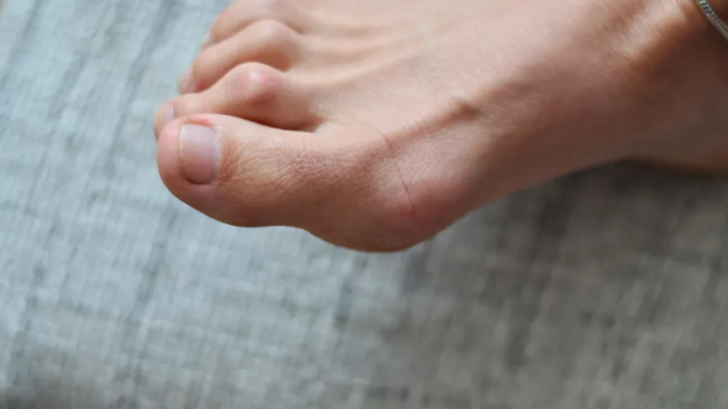 One foot of a woman was cause of the hammertoe problem, in which all of the toes were misaligned.