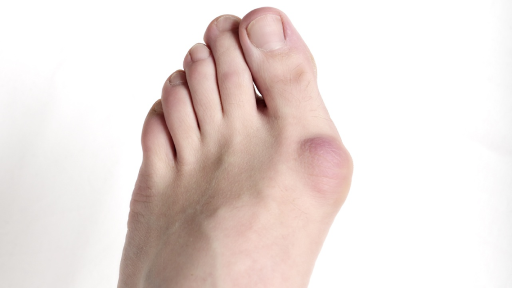 a foot with bunion