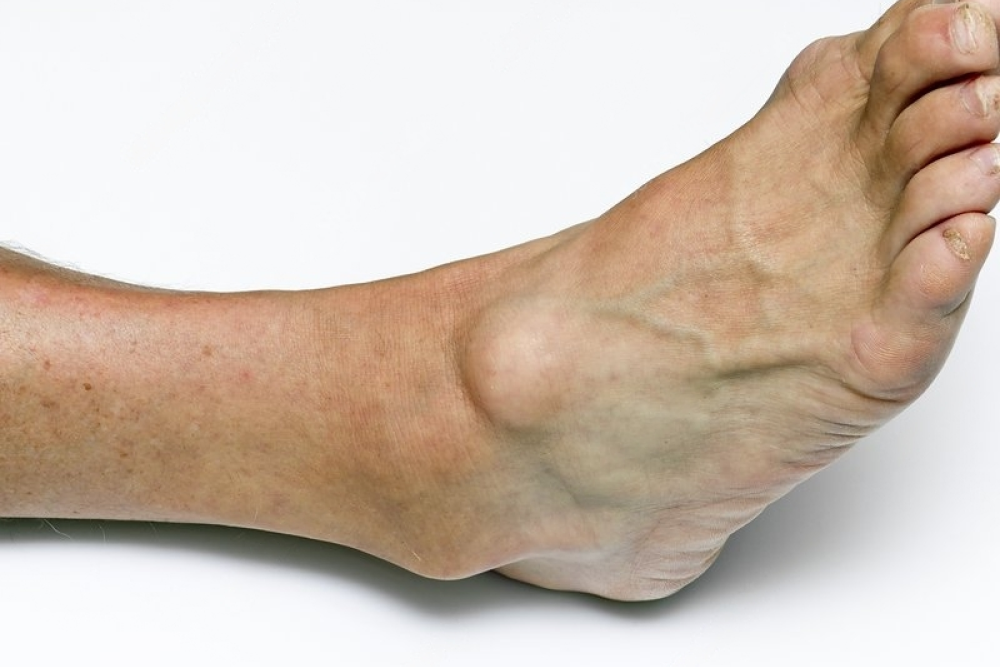 a foot with soft tissue mass