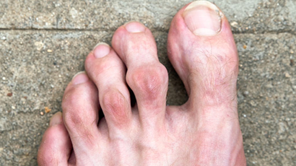 foot hammertoe