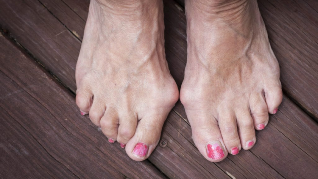 feet with bunions can cause feet deformation