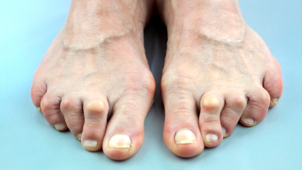 womans feet with hammertoe