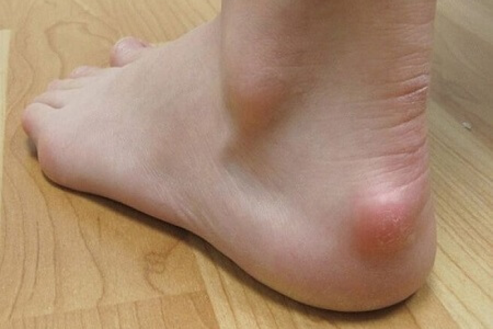 lump on heel