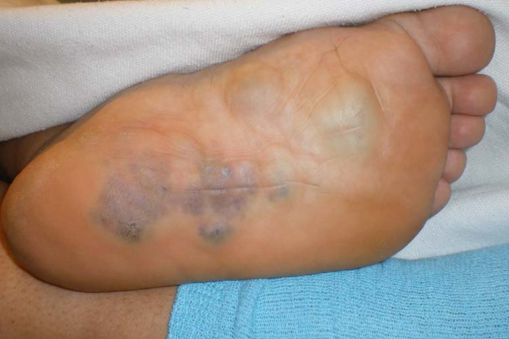 foot with purple lump