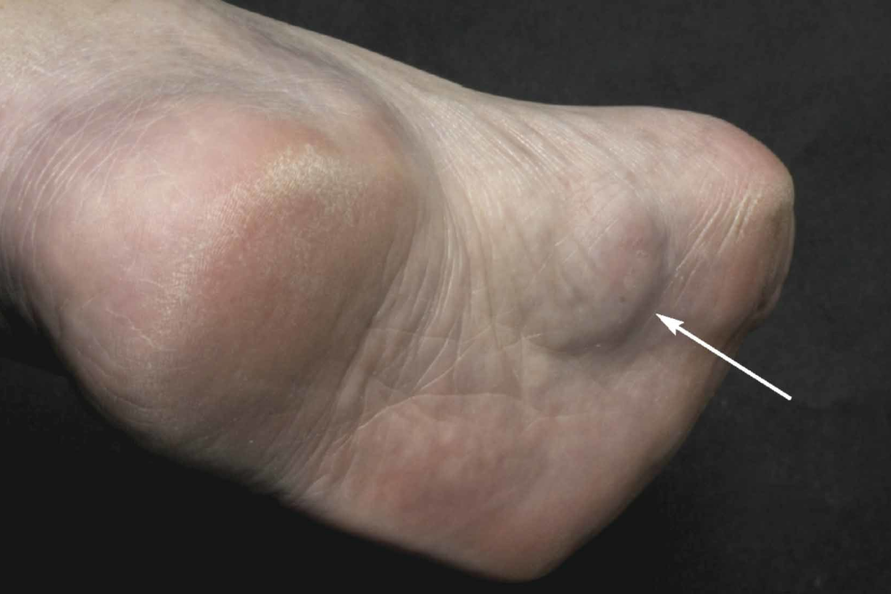 Patients' soles of feet are almost expanding.