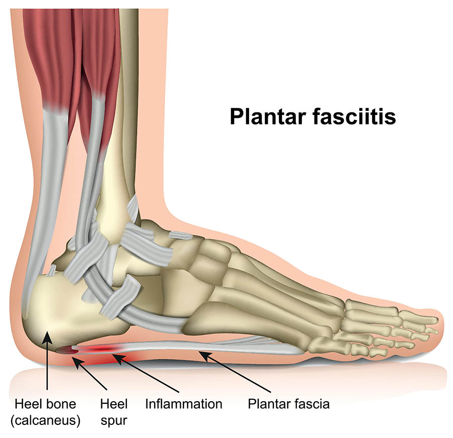 Plantar fasciitis Disease's Components