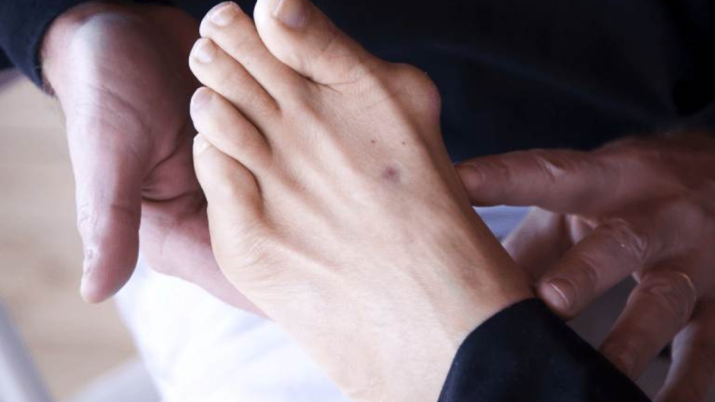 symptoms of a bunion in female's foot