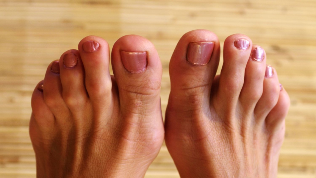 A woman shows her hammertoe afflicted feet.