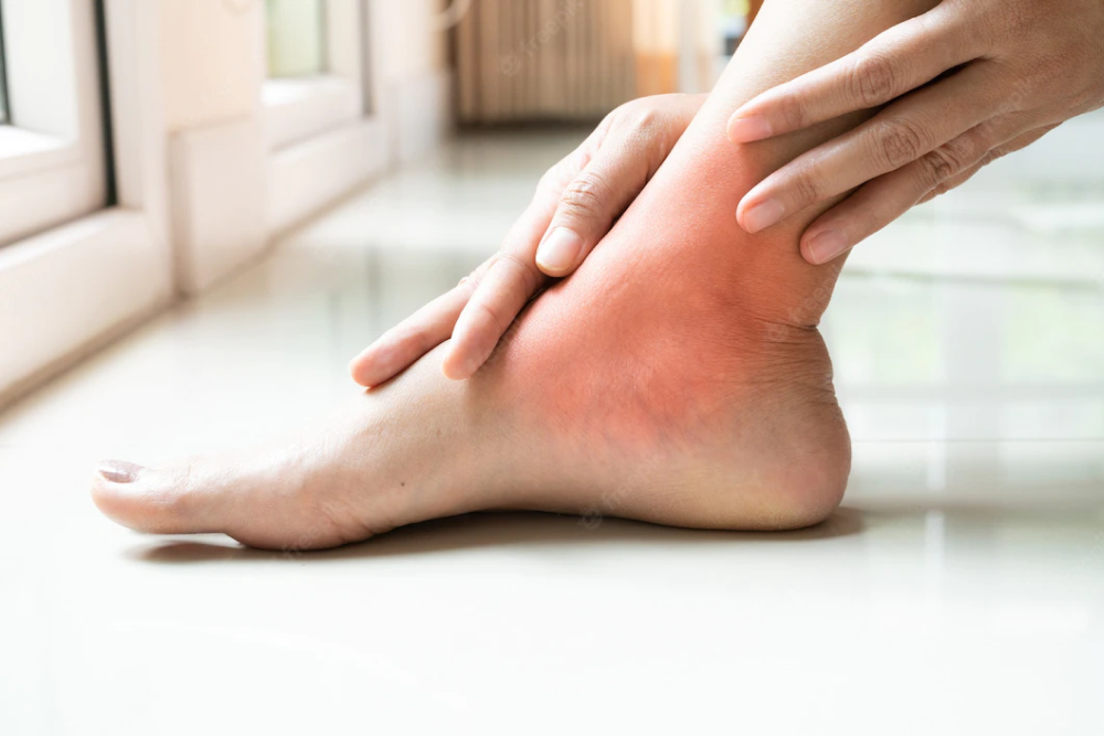 An ankle area swelling on a woman's foot due to tendon problems.