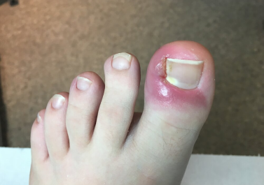 feet with Ingrown Toenails